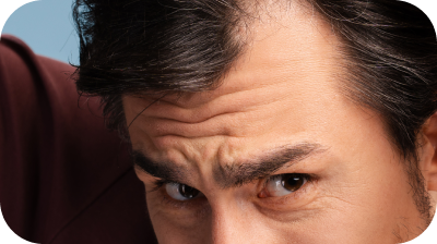 Panduan lengkap mengatasi rambut rontok pada pria